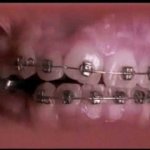 Aparelho Dentário Fazendo Milagre Aparelho Dentário Fazendo Milagre