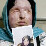 Iraniana Perdoa Homem que a Desfigurou com Ácido