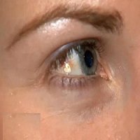 Mulher Gasta 7 Mil Reais Para Implantar Joia de Platina no Olho