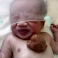 Bebê Chinês Nasceu com o Coração Fora do Corpo