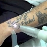 Como Remover Sua Tatuagem em Poucos Minutos