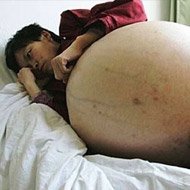 Mulher com Tumor Gigantesco de 50kg