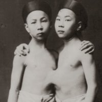 10 Casos de Gêmeos Siameses que Marcaram a História