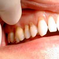 O que Ã© ErosÃ£o DentÃ¡ria e Como Tratar
