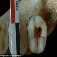 Cárie Dentária de 14 Mil Anos Foi Tratada com Pedra Afiada